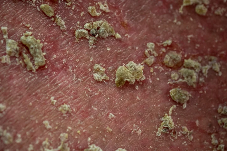 What is seborrheic keratosis and do I have it?