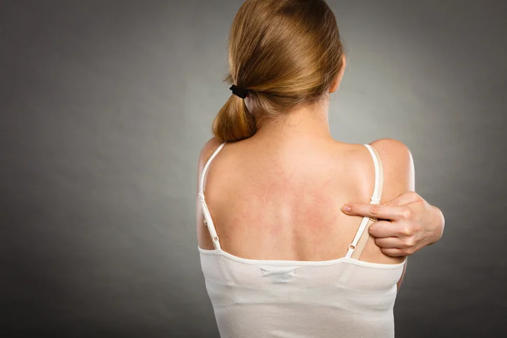 Eczema vs psoriasis: What’s the difference? 