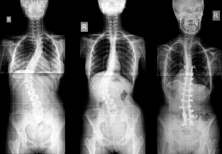 Subtle signs you may have scoliosis