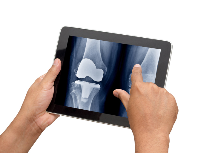 How long does a hip or knee replacement last?