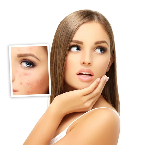 Preventing rosacea when the weather turns cold