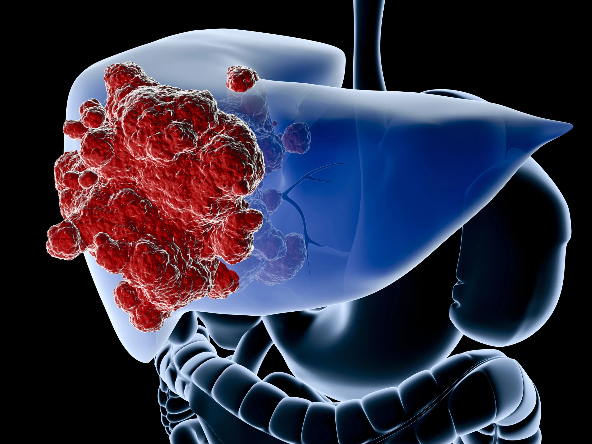 The silent liver disease you may have