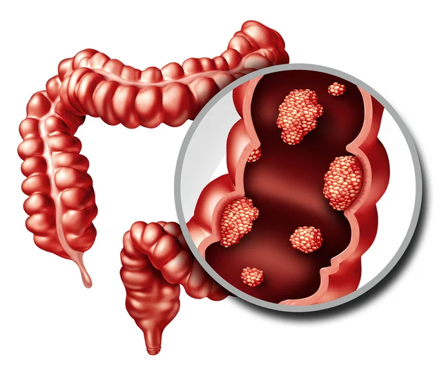 Critical facts on colorectal polyps