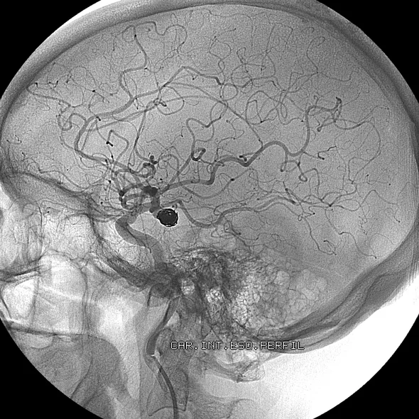 Are you at risk for a brain aneurysm?