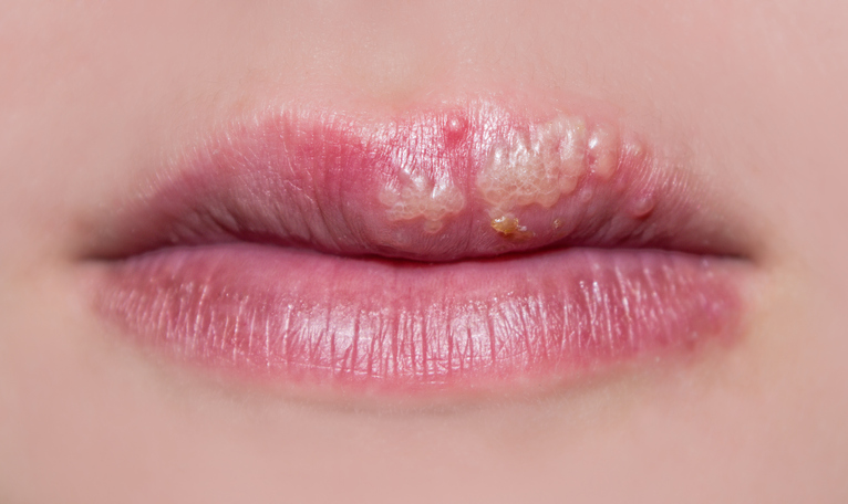 Cold sore vs. canker sore: What’s the difference?
