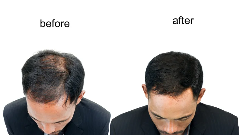 Understanding male pattern baldness