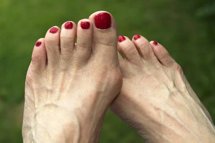 What to know and do about bunions