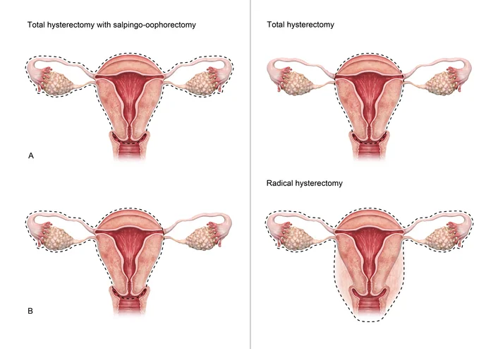 Surprising reasons why women sometimes need a hysterectomy 