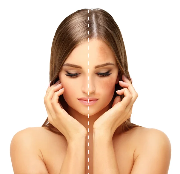 Melasma and women: What it is and how to treat it 