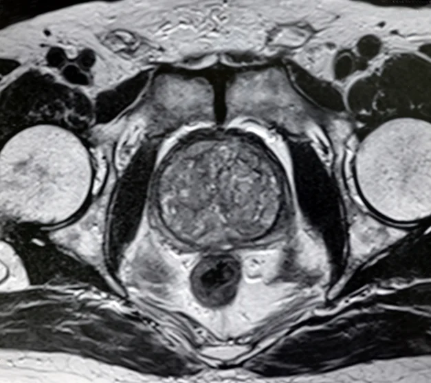 What men should know about prostatitis 