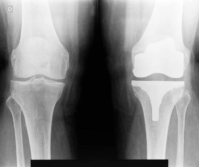 Activities you can do after a total knee replacement