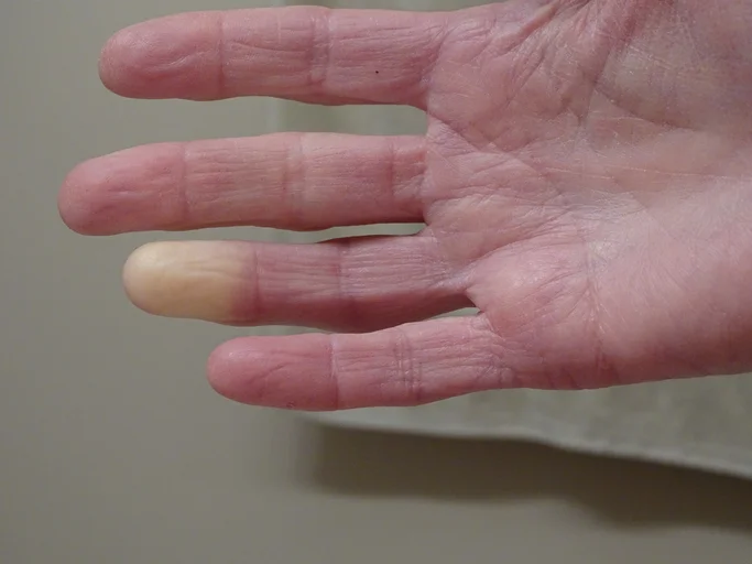Recognizing Raynaud’s Syndrome