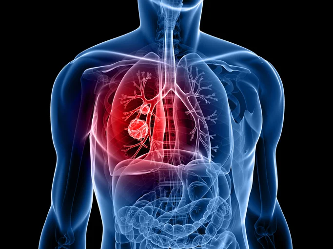 Early diagnosis key to surviving lung cancer 