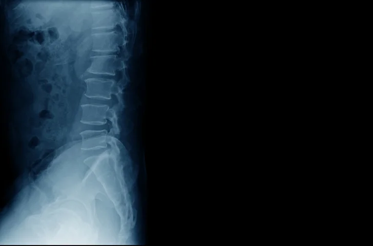 Must know facts about degenerative disc disease 