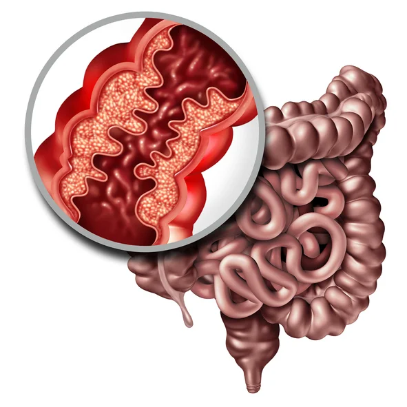 Understanding the similarities and differences between Crohn’s disease and Ulcerative Colitis &nbsp;