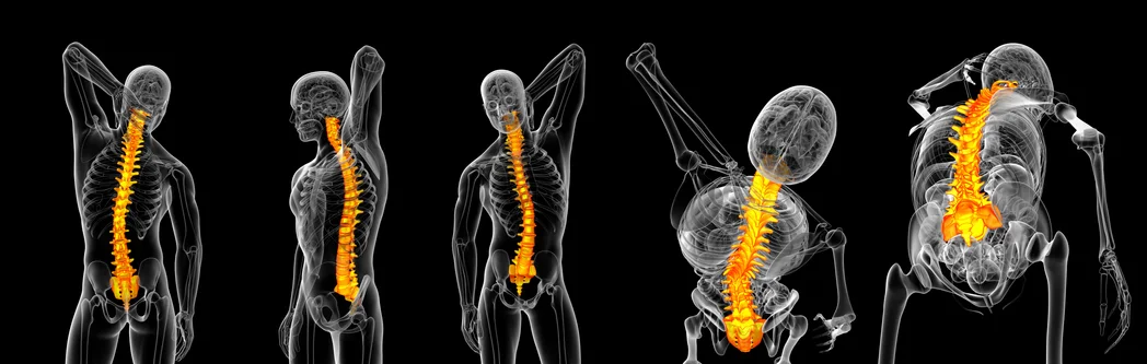 Osteoporosis: Often overlooked and undertreated in men