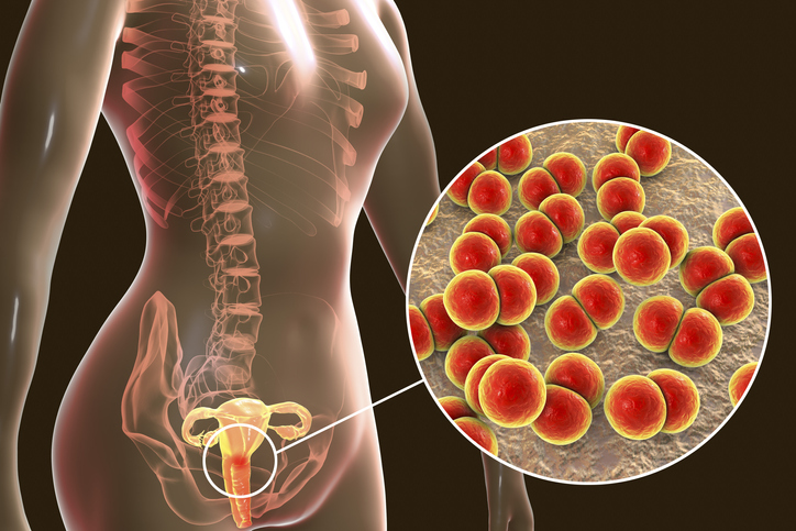 Health risks associated with untreated gonorrhea