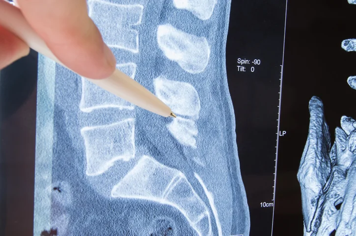 4 Facts to know about herniated discs