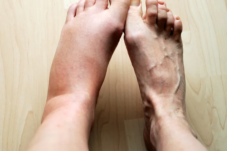 Best treatments for swollen feet or ankles 