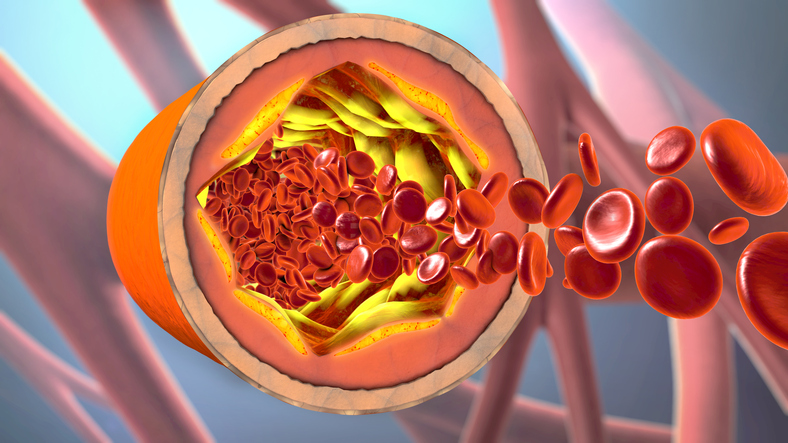 Portfolio Diet: Your recipe for lowering cholesterol