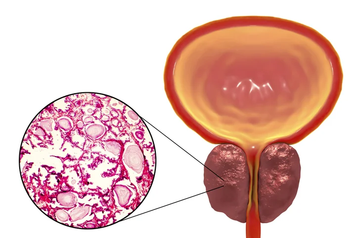 How to get the best results from a prostate biopsy