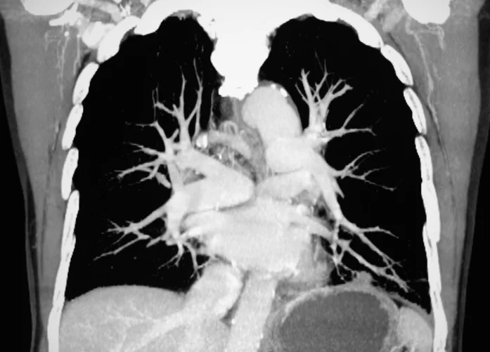 Could you be at risk for a pulmonary embolism?