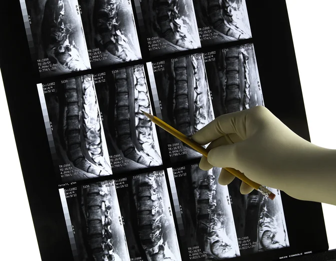When should screening for osteoporosis begin?