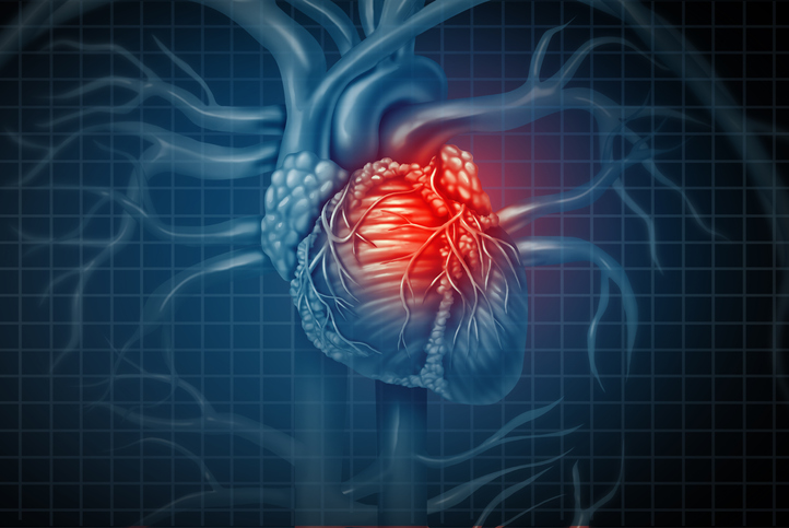 Varicoceles in men may increase heart disease risk