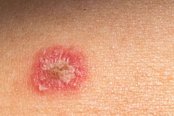 Cellulitis – a skin infection not to ignore 