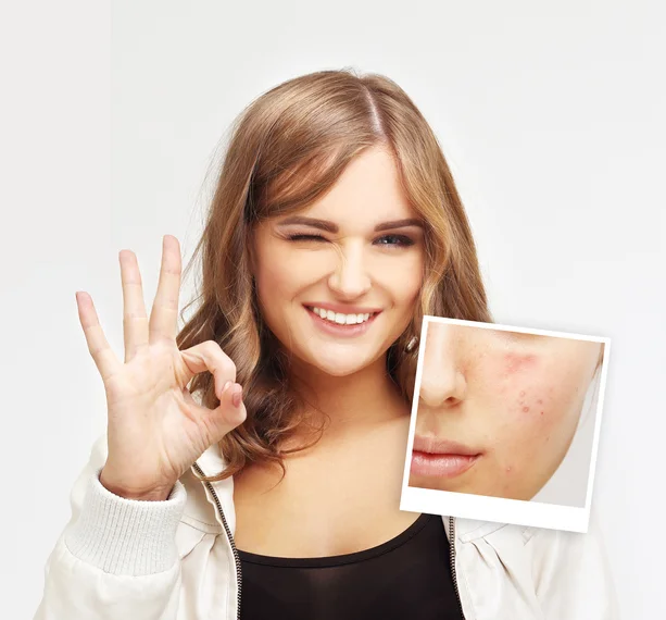 Rosacea: The blush that won’t go away