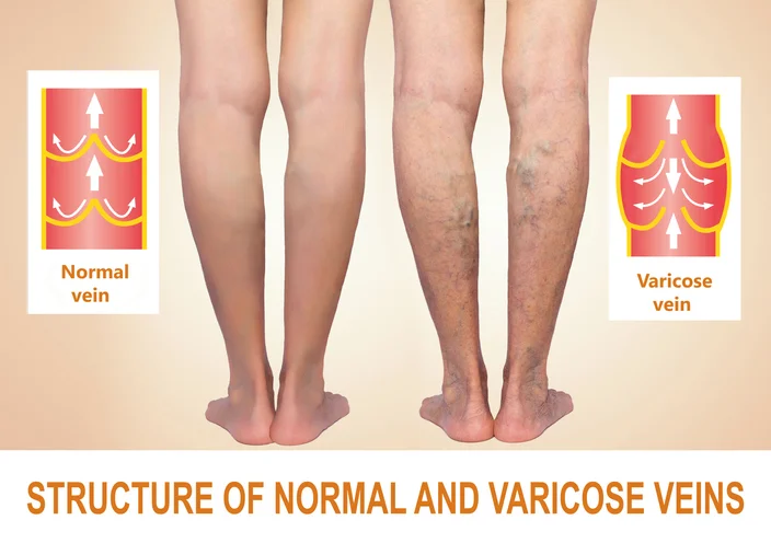 Best tips for reducing and reversing varicose veins
