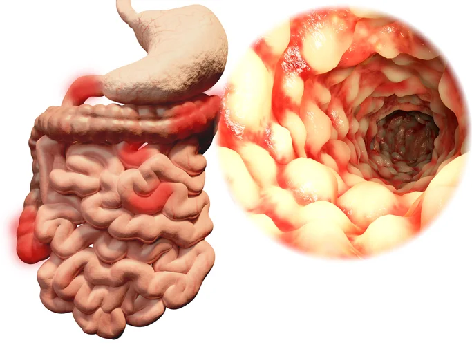 Inflammatory Bowel Disease: How it affects male fertility