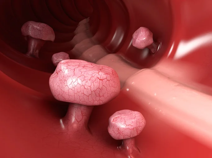 Facts you should know about polyps