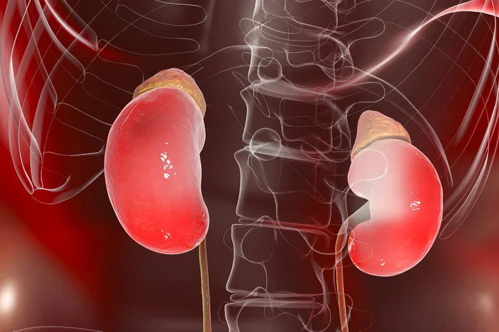 Food choices preventing chronic kidney disease from progressing