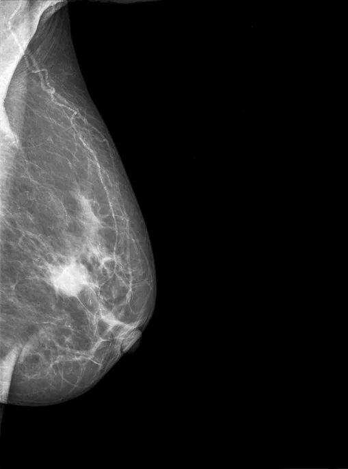 FDA proposes new mammogram guidelines for women with dense breasts