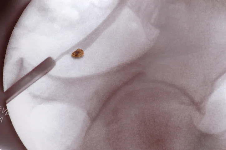 What you should know about bladder stones
