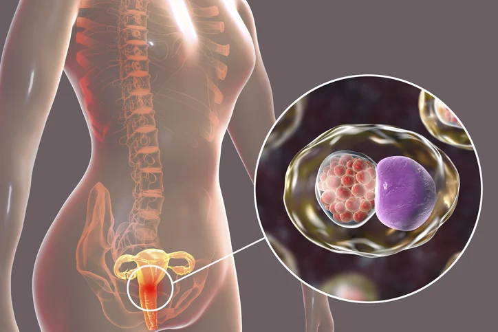 Understanding cervicitis in women