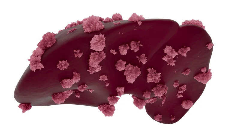 Hepatocellular Cancer (Hcc) Or Malignant (Cancerous) Nodules On A Liver. Medical Science And Research Concept