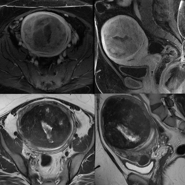 Uterine fibroids effect on your sex life