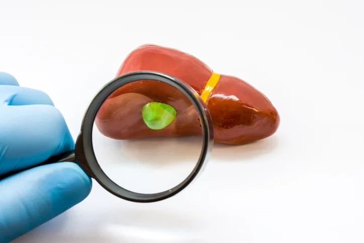 Top tips for preventing gallstones 