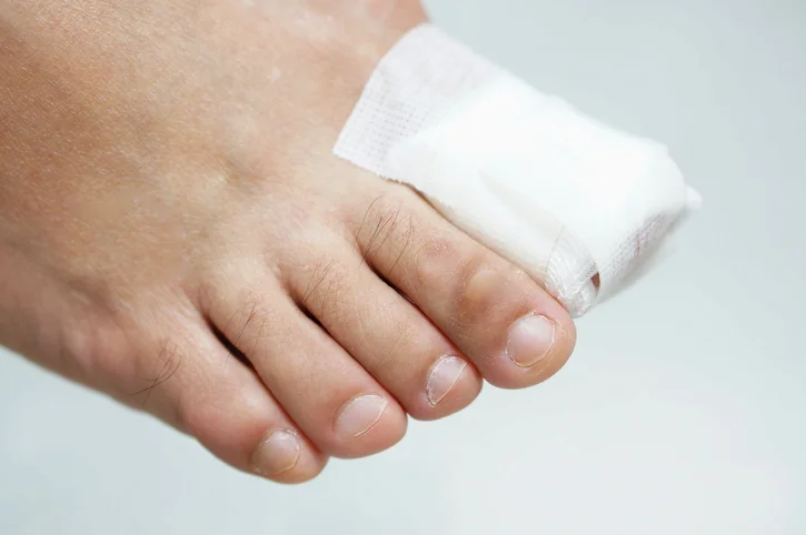Prevention key for avoiding diabetic foot ulcers
