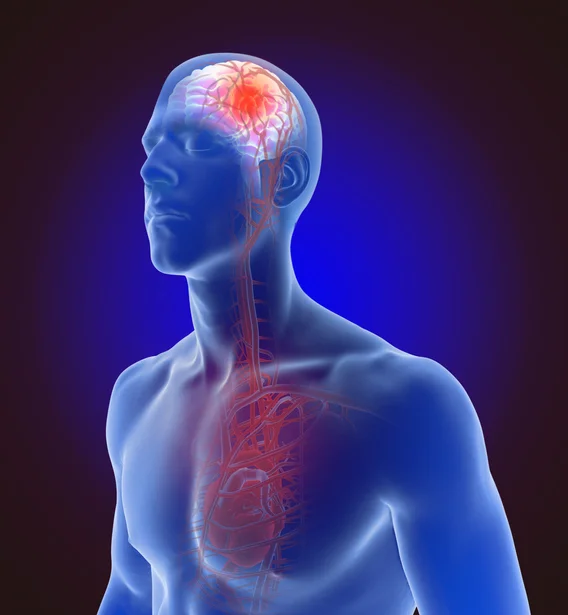 15 essential facts about stroke