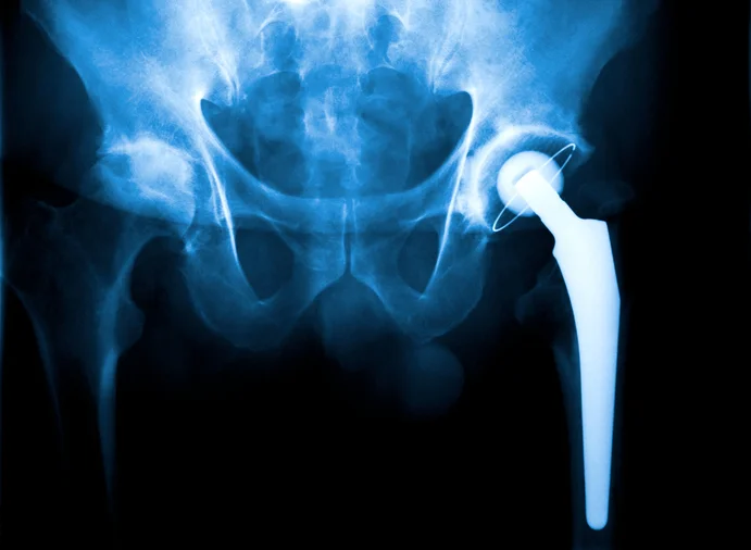 Is it time for a hip replacement?
