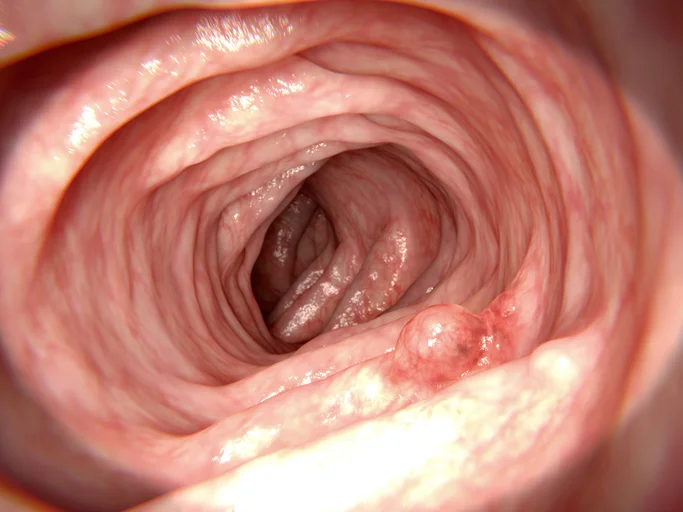 What is the significance of having a colon polyp? 
