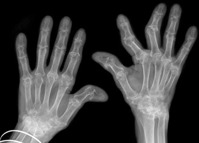 5 Must-know facts about rheumatoid arthritis