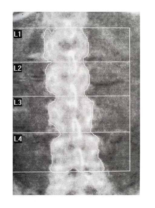 Study finds young adults at high risk for osteopenia