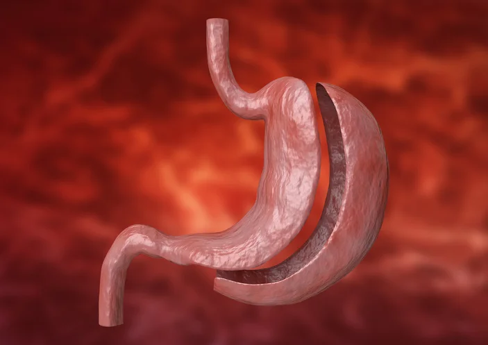 Separating fact from fiction of bariatric surgery