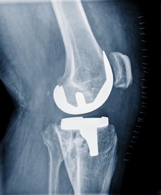 Total knee replacement surgery: It is time?