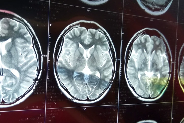 7 Unforeseen factors increasing your risk of stroke