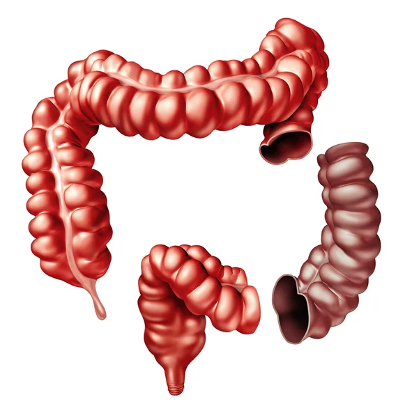  Why that pain in your side might be diverticular disease